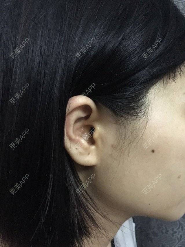 更美 - 本是完美的妞😄的鼻部多项经验 | 鼻部整形 | 自体耳软骨垫鼻尖 | 鼻部多项 | 广州