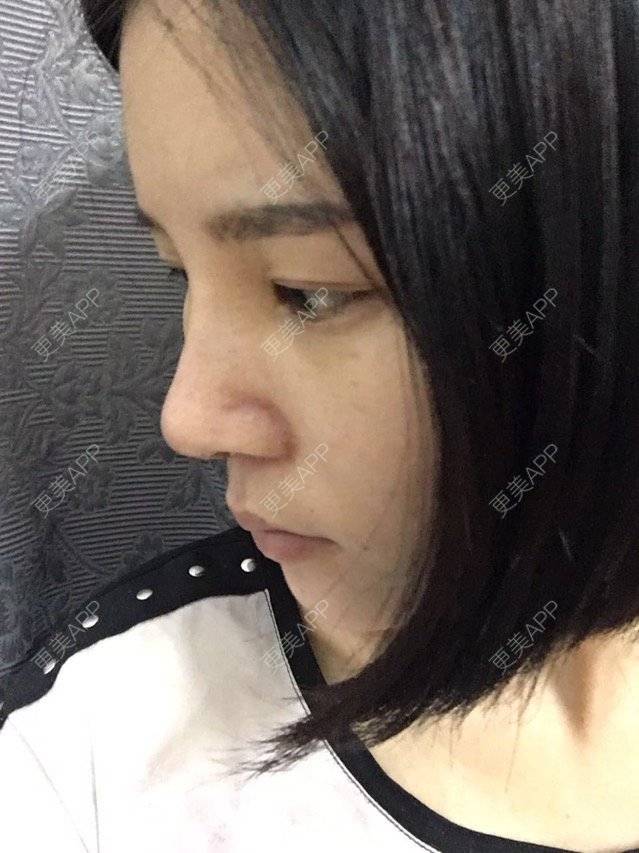 更美 - 本是完美的妞😄的鼻部多项经验 | 鼻部整形 | 自体耳软骨垫鼻尖 | 鼻部多项 | 广州