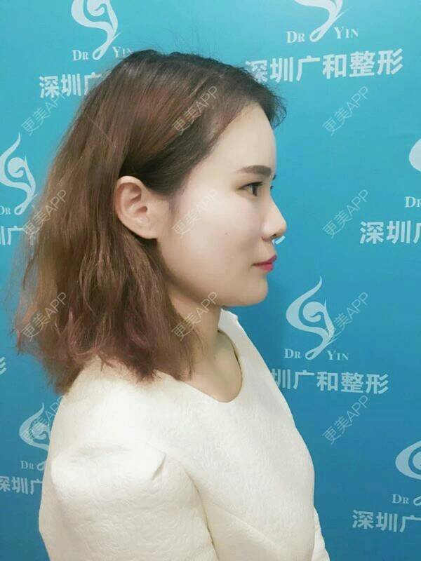 更美 - 黄丽华 医生的自体脂肪全面部填充经验 | 自体脂肪全面部填充 | 深圳