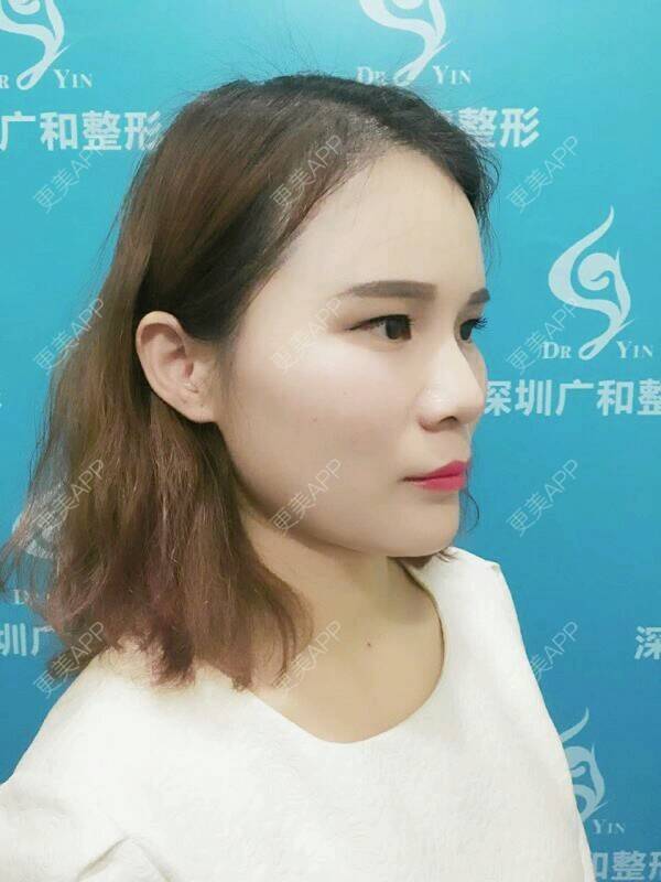 更美 - 黄丽华 医生的自体脂肪全面部填充经验 | 自体脂肪全面部填充 | 深圳
