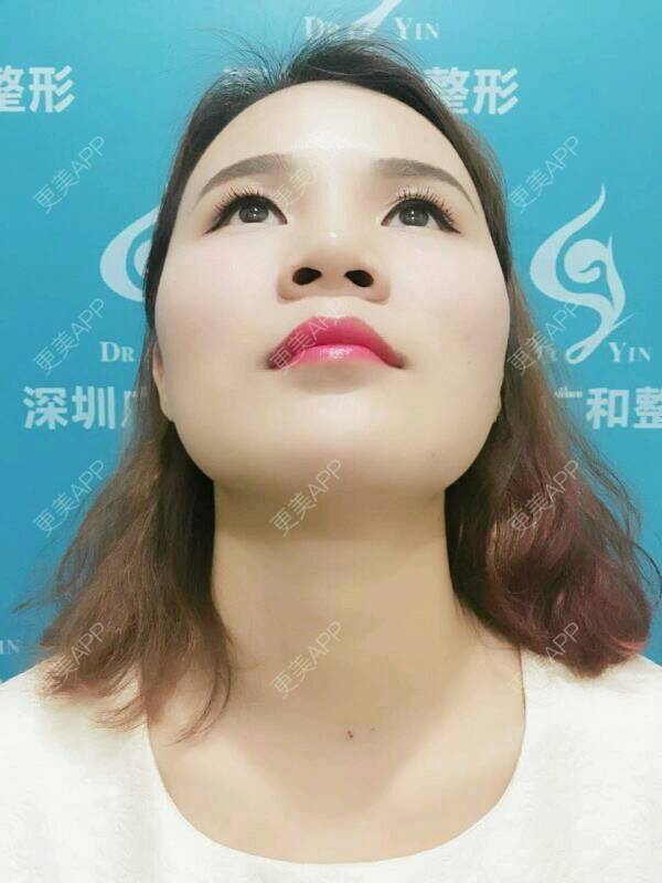更美 - 黄丽华 医生的自体脂肪全面部填充经验 | 自体脂肪全面部填充 | 深圳