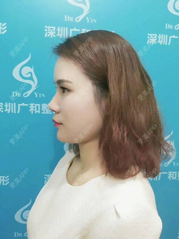 更美 - 黄丽华 医生的自体脂肪全面部填充经验 | 自体脂肪全面部填充 | 深圳