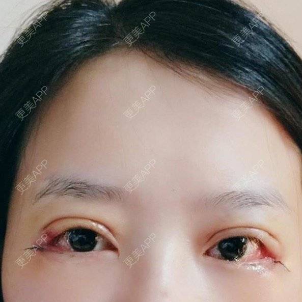 更美 - 晶晶的的开外眼角日记 | 开外眼角 | 双眼皮 | 韩国绮林整形