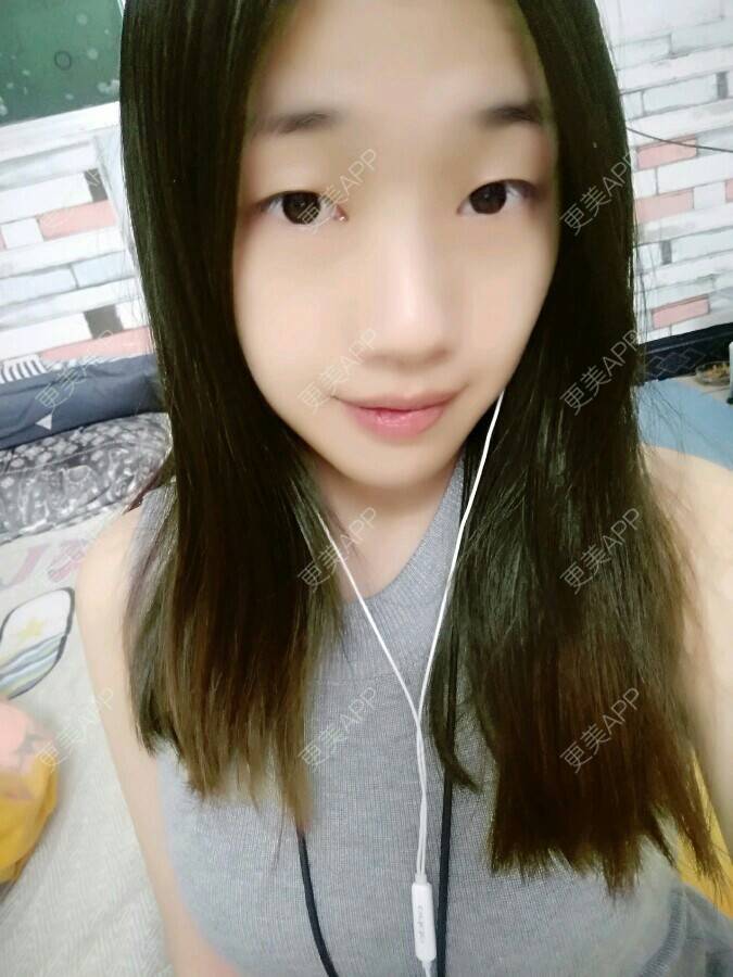 更美 - 更美用户97050482的经验 | 内开眼角 | 双眼皮 | 开外眼角 | 湛江