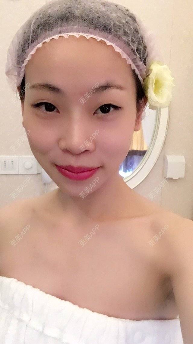 更美 - 易珊的经验 | 假体垫下巴 | 双眼皮 | 中山