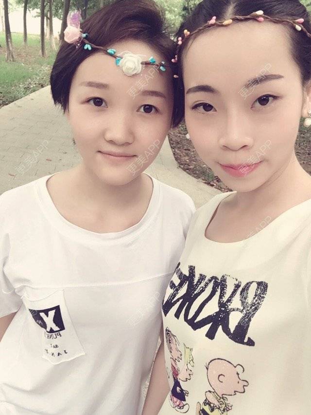 更美 - 易珊的经验 | 假体垫下巴 | 双眼皮 | 中山
