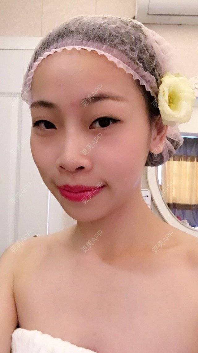 更美 - 易珊的经验 | 假体垫下巴 | 双眼皮 | 中山