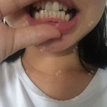 整牙整牙