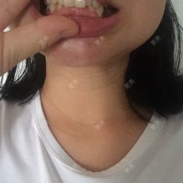 整牙整牙