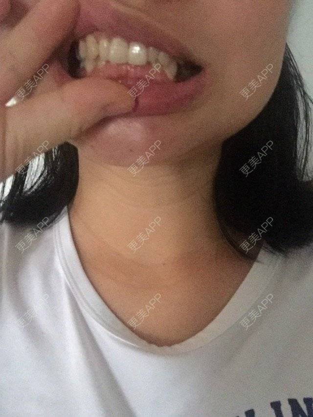 更美 - 整牙整牙的经验 | 牙齿矫正 | 口腔齿科 | 深圳