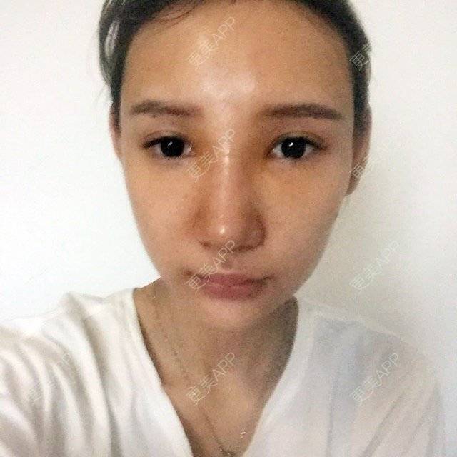 更美 - 要变韩国欧尼酱的经验 | 南京 | 隆鼻 | 缩鼻头手术