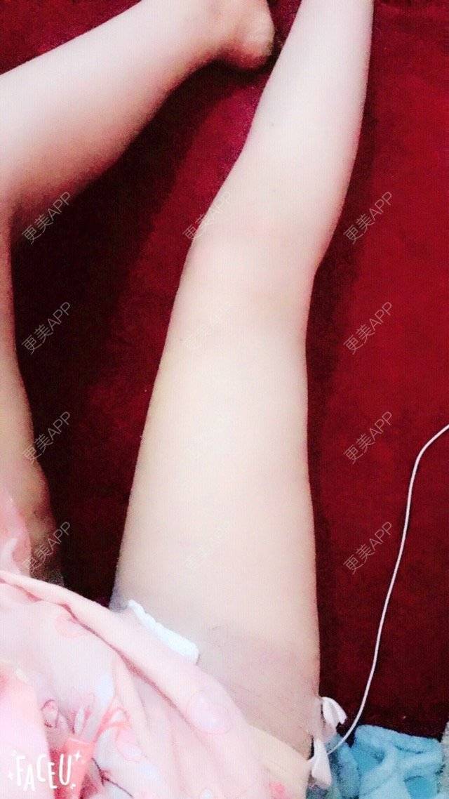 更美 - zoeiii的经验 | 吸脂瘦大腿 | 温州
