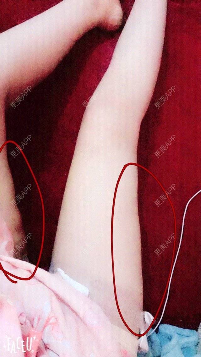 更美 - zoeiii的经验 | 吸脂瘦大腿 | 温州