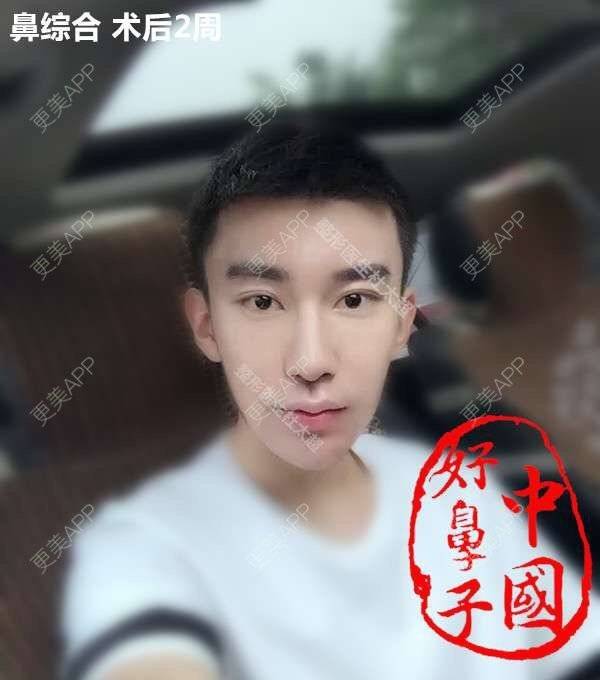更美 - 杜太超 医生的经验 | 耳软骨鼻尖 | 隆鼻 | 鼻部多项 | 北京