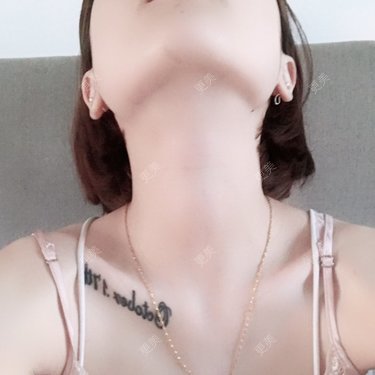 下颌角