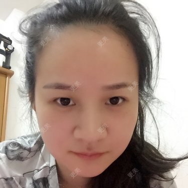 双眼皮