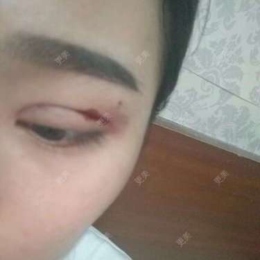 眼部整形