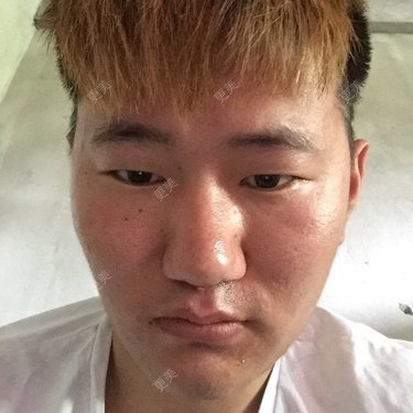 双眼皮