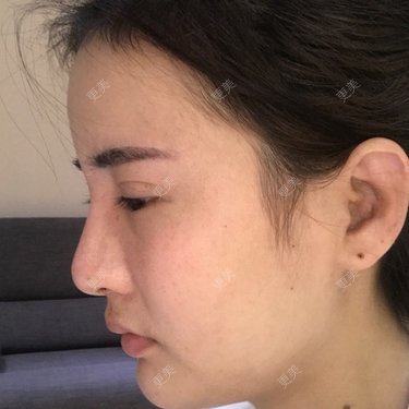 鼻部整形