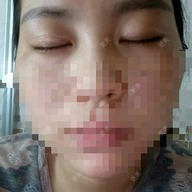 眼部整形