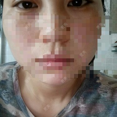 眼部整形