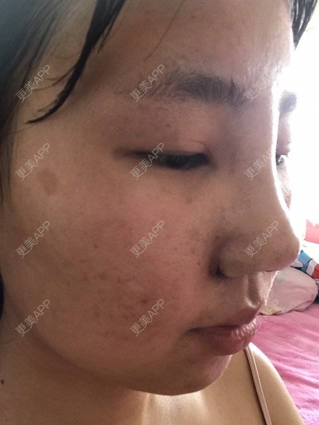 更美 - mzmiss的经验 | 鼻翼 | 隆鼻 | 鼻部多项 | 南昌