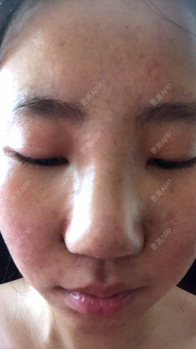 更美 - mzmiss的经验 | 鼻翼 | 隆鼻 | 鼻部多项 | 南昌