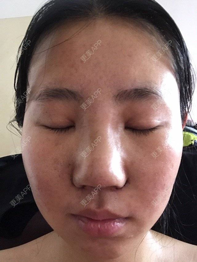 更美 - mzmiss的经验 | 鼻翼 | 隆鼻 | 鼻部多项 | 南昌