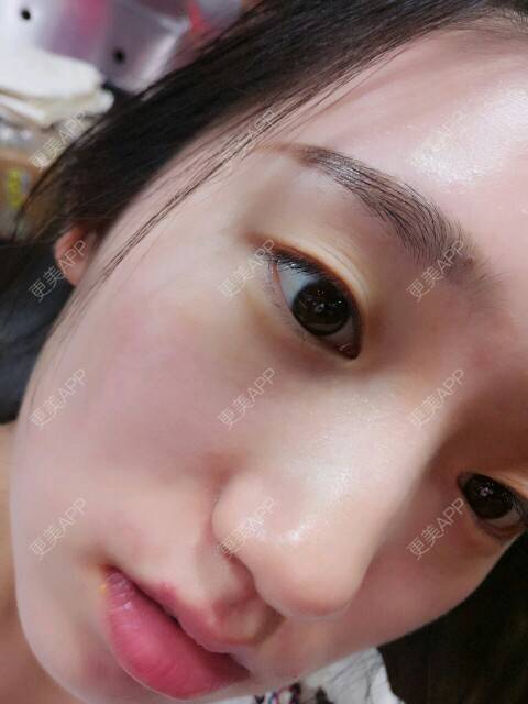 更美 - 更美用户gpWyI6ySli的经验 | 双眼皮 | 阿里
