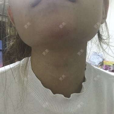注射美容