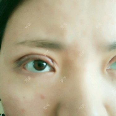 眼部整形