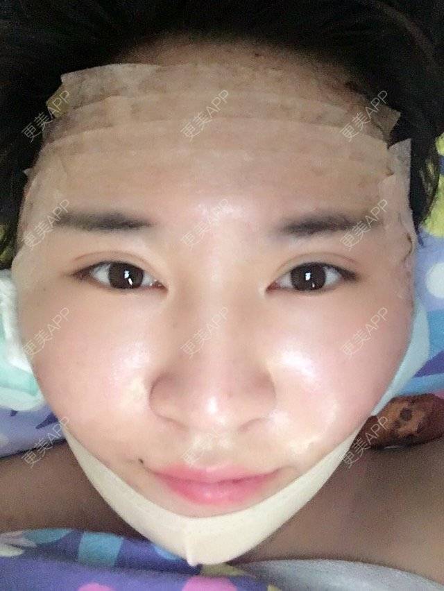 更美 - kara酱的吸脂瘦大腿经验 | 臀部吸脂手术 | 双下巴吸脂 | 吸脂瘦大腿 | 成都