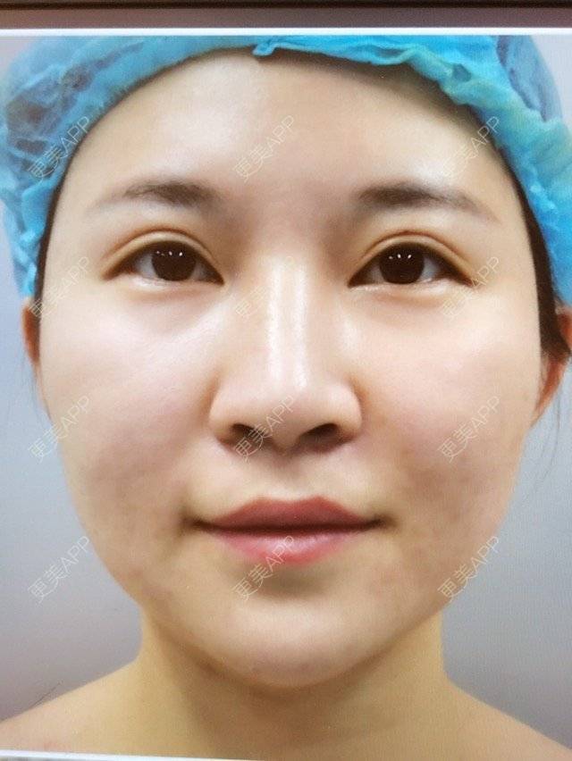 更美 - kara酱的吸脂瘦大腿经验 | 臀部吸脂手术 | 双下巴吸脂 | 吸脂瘦大腿 | 成都