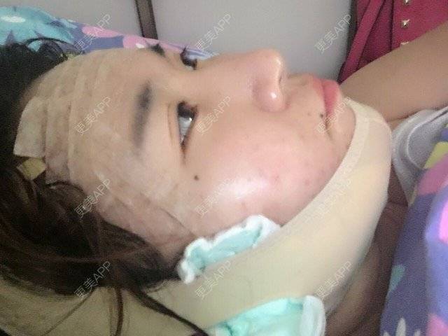 更美 - kara酱的吸脂瘦大腿经验 | 臀部吸脂手术 | 双下巴吸脂 | 吸脂瘦大腿 | 成都
