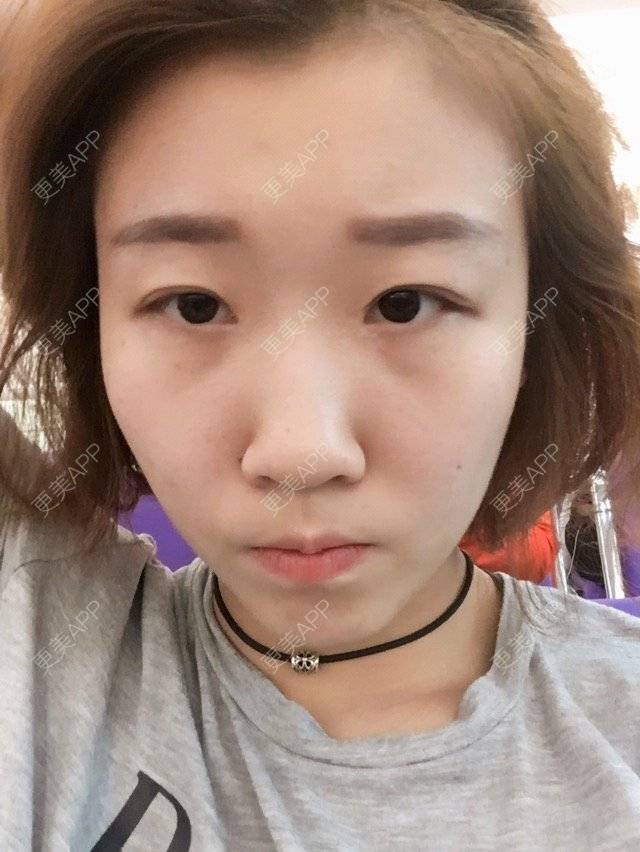 更美 - Monica. 莫莫张✨的经验 | 热拉提 | 玻尿酸 | 北京