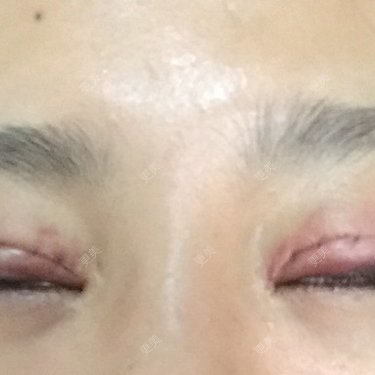双眼皮