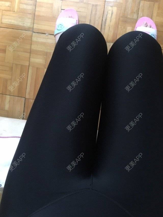 更美 - 大ci小ci的吸脂瘦大腿经验 | 成都 | 吸脂小腿 | 吸脂瘦大腿