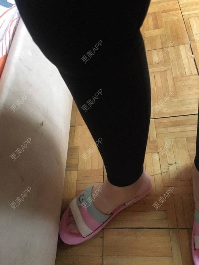 更美 - 大ci小ci的吸脂瘦大腿经验 | 成都 | 吸脂小腿 | 吸脂瘦大腿