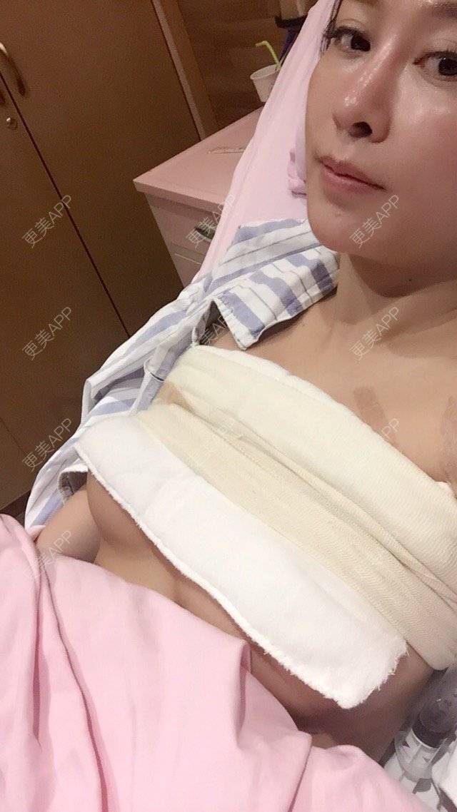 更美 - 再见告白气球的假体隆胸经验 | 假体隆胸 | 成都