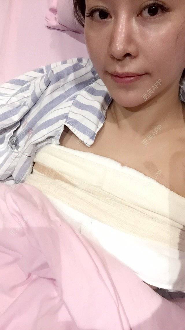 更美 - 再见告白气球的假体隆胸经验 | 假体隆胸 | 成都