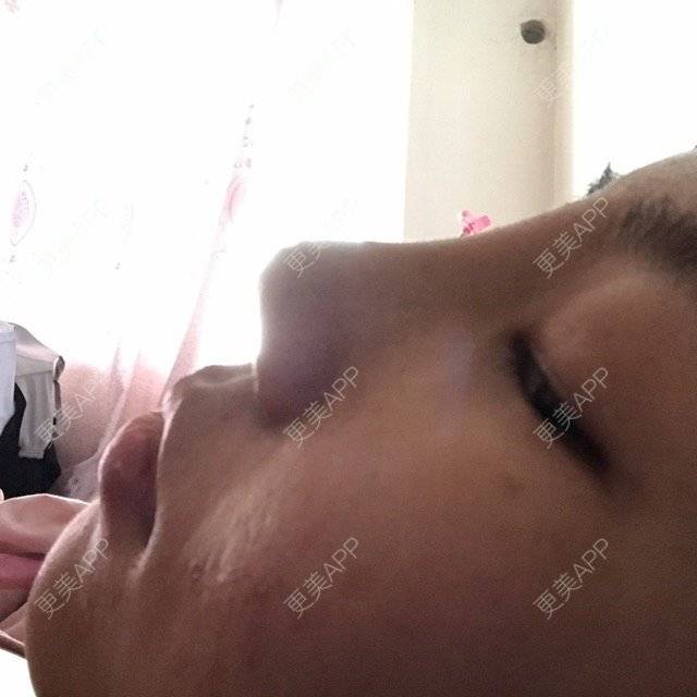 更美 - mzmiss的经验 | 鼻翼 | 隆鼻 | 鼻部多项 | 南昌