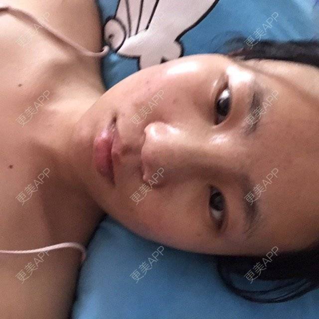 更美 - mzmiss的经验 | 鼻翼 | 隆鼻 | 鼻部多项 | 南昌