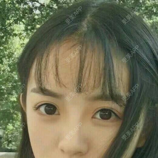 更美 - 萌了个林的经验 | 开内眼角 | 眼部整形 | 双眼皮 | 厦门