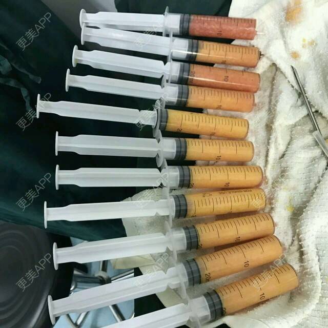 更美 - 魔法少女金克斯的自体脂肪隆胸经验 | 自体脂肪隆胸 | 隆胸日记 | 胸部塑身 | 天津