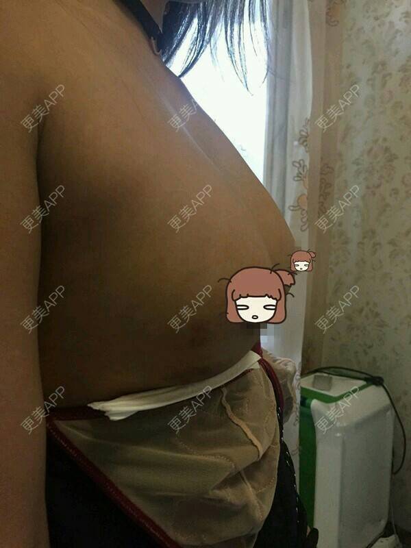 更美 - 魔法少女金克斯的自体脂肪隆胸经验 | 自体脂肪隆胸 | 隆胸日记 | 胸部塑身 | 天津