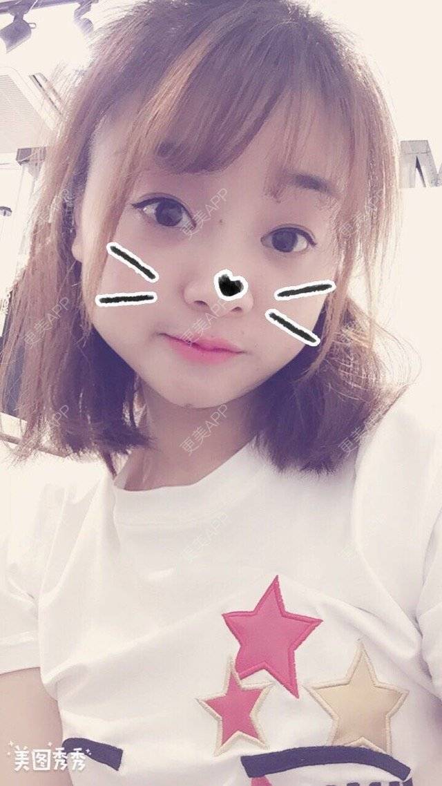 更美 - Mimo 兰的眼皮下垂矫正经验 | 上海 | 眼皮下垂矫正