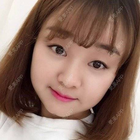 更美 - Mimo 兰的眼皮下垂矫正经验 | 上海 | 眼皮下垂矫正