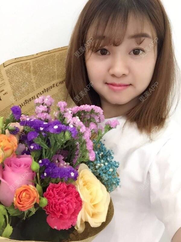 更美 - Mimo 兰的眼皮下垂矫正经验 | 上海 | 眼皮下垂矫正