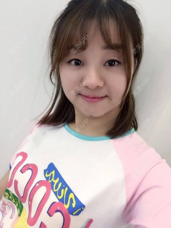 更美 - Mimo 兰的眼皮下垂矫正经验 | 上海 | 眼皮下垂矫正