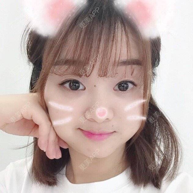 更美 - Mimo 兰的眼皮下垂矫正经验 | 上海 | 眼皮下垂矫正